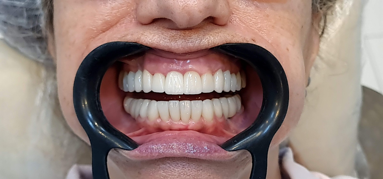 Resultado clínico do sorriso após o tratamento estético