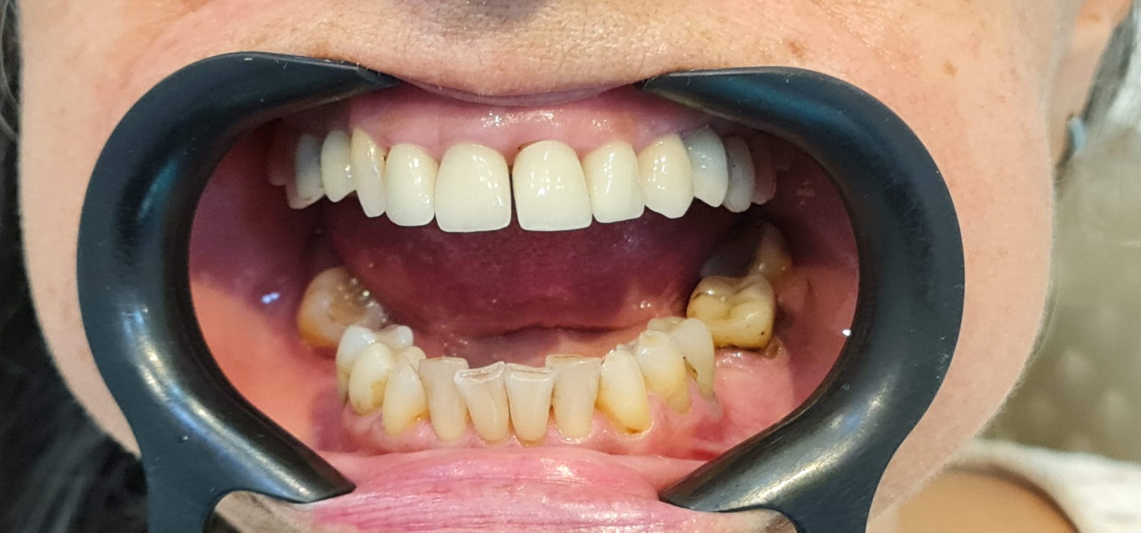 Situação inicial do paciente antes da reabilitação oral com implantes