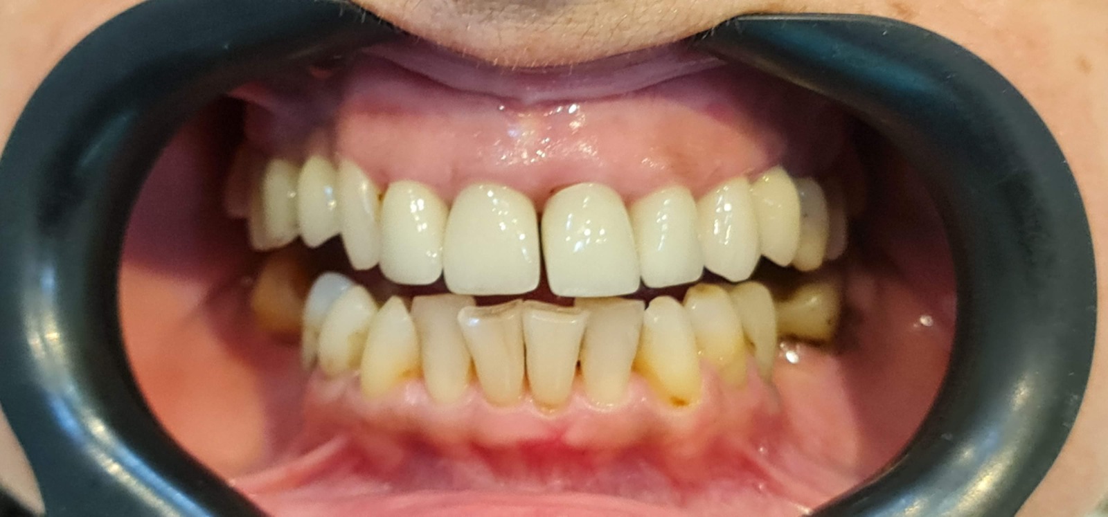 Situação clínica inicial do sorriso antes do tratamento estético