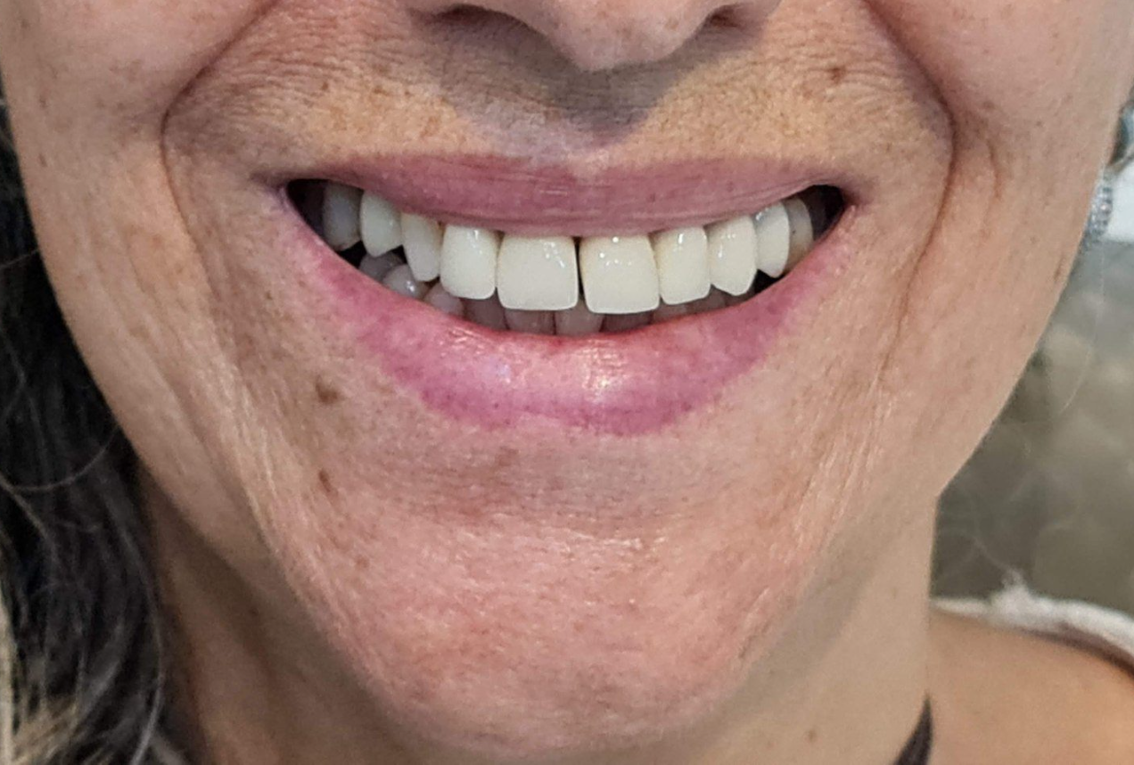 Condição inicial do sorriso antes da simulação estética digital