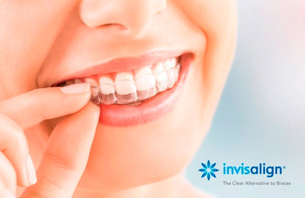 10 dúvidas sobre Invisalign respondidas aqui! - SNG Odontologia